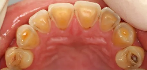 歯の裏側